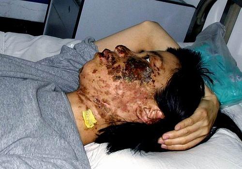 7. svibnja 2004., lice Gao Rongrong je prekriveno opeklinama zbog šokova električnih palica. Ove slike su snimljene deset dana nakon mučenja 