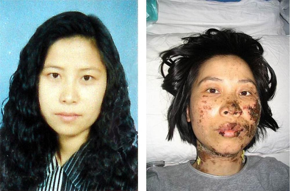 Opekline gospođe Gao Rongrong, prije (lijevo) i poslije (desno) šokiranja elektičnim palicama.