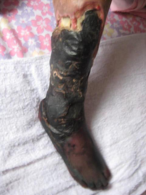 Nakon injekcije nepoznatih lijekova, desna noga i stopalo gospođe Song Huilan  od gnojenja je pocrnilo.