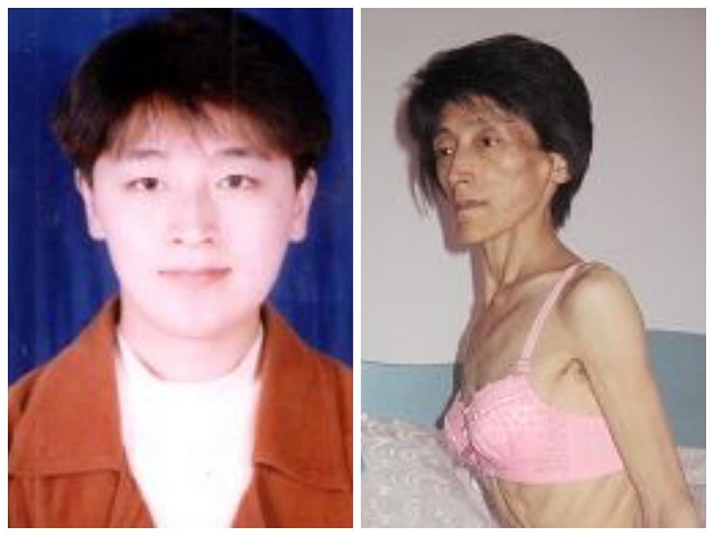 Gospođa Song Yanqun (lijevo) je smršavila (desno) zbog prisilnog uzimanja nepoznatih lijekova.