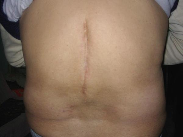 Fotografija leđa praktikanta Qing Yana na kojoj se vidi ožiljak dužine 15 centimetara. 