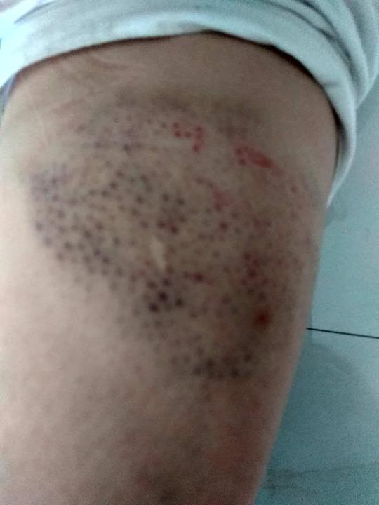 Ozljede čela i ruke gospođe Zhang