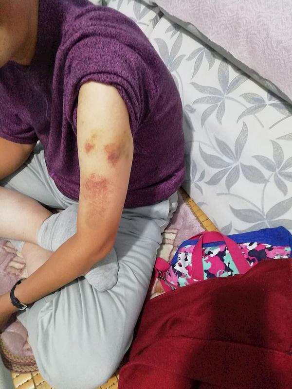 Modrice na ruci gospođe Ji i dalje su bile vrlo tamne 10 dana kasnije